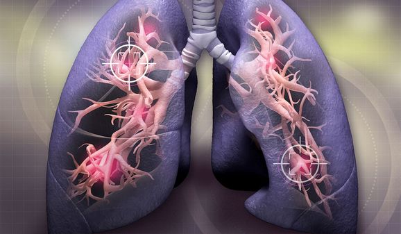 Таблетки от рака легких снижают риск смерти вдвое - исследование